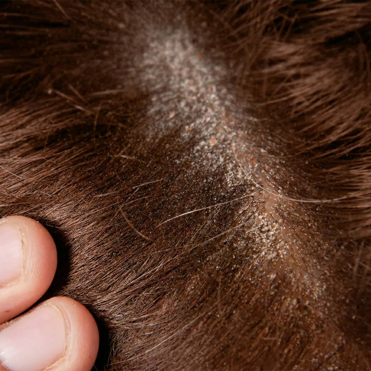 Dry scalp before using Kadura Shampoo